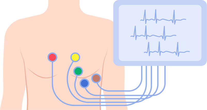 EKG ECG arrhythmias Irregular rhythms palpitation electrical coronary artery attack chest pain disease signal test screening monitor holter stress Implantable loop recorder